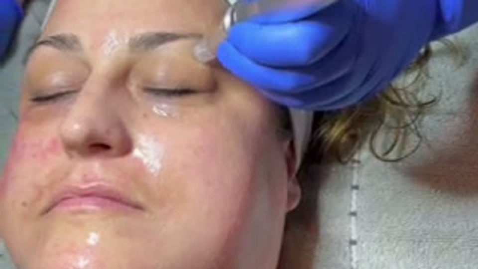 Micro needle + Microcurrent Facial